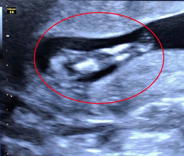Hiếm gặp: Phát hiện một trường hợp thai nhi mắc hội chứng… người cá - Ảnh 1.