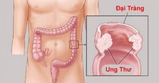 Nhiều người cùng mắc ung thư trong 1 gia đình: BS chỉ ra thủ phạm - Ảnh 1.