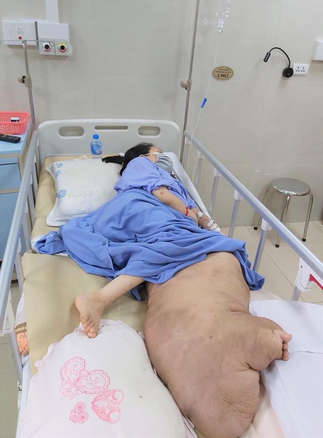 Hãi hùng khối u nặng... 42kg vừa được BV Đại học Y Hà Nội cắt bỏ - Ảnh 1.