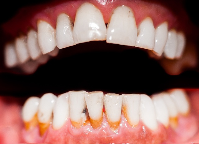 Những bệnh lý răng miệng có thể gây mất răng vĩnh viễn - Ảnh 2.