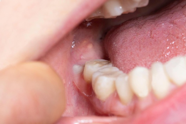 Những bệnh lý răng miệng có thể gây mất răng vĩnh viễn - Ảnh 3.