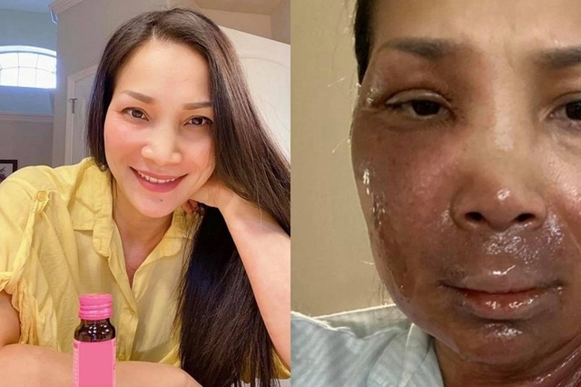 Hồng Ngọc thấy trẻ đẹp hơn sau tai nạn bỏng - Ảnh 2.