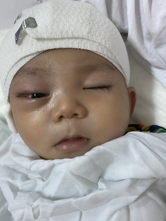 Xót thương bé trai dân tộc Nùng 7 tháng tuổi bị khối u đẩy lồi mắt ra ngoài - Ảnh 3.