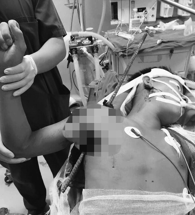 Tránh viên gạch rơi vào đầu, thanh niên 19 tuổi ở Hà Nội bị thanh sắt đâm thủng vai - Ảnh 1.