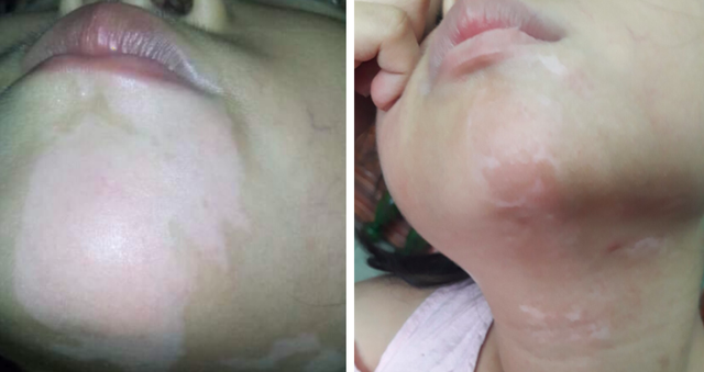 Bệnh nhi đầu tiên, nhỏ tuổi nhất Việt Nam chữa lành bạch biến nhờ ghép tế bào tự thân - Ảnh 2.