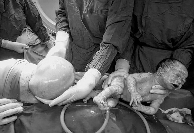 Một bé trong đôi song sinh chào đời nguyên bọc ối - Ảnh 1.
