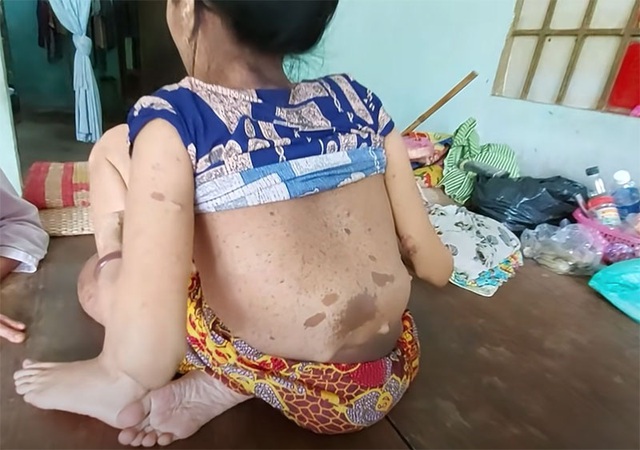 Cảnh đời buồn của người phụ nữ có chân to nhất Việt Nam - Ảnh 3.