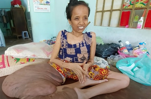 Cảnh đời buồn của người phụ nữ có chân to nhất Việt Nam - Ảnh 5.