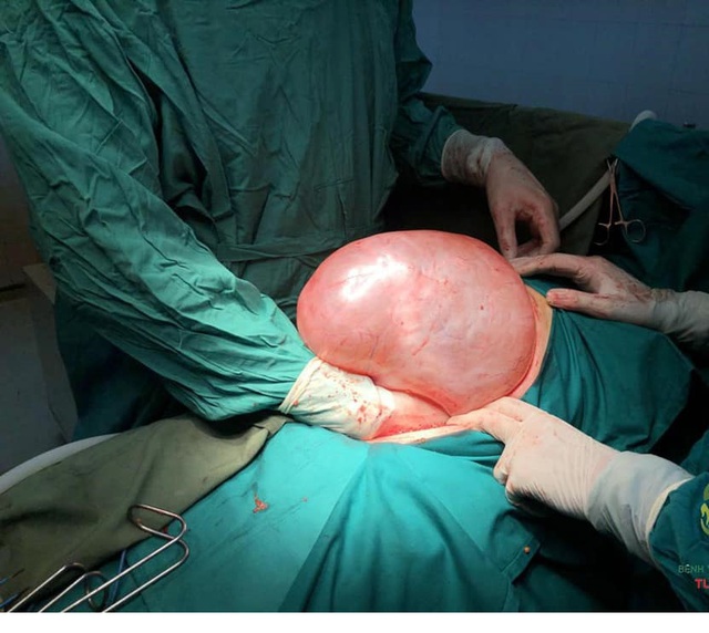 Chủ quan khi bụng to nhanh, người phụ nữ giật mình khi mang khối u nặng gần 9kg - Ảnh 2.