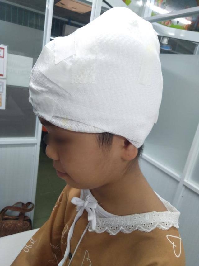 Tóc bị cuốn vào máy cưa đá, bé gái bị lột hơn 1/2 da đầu - Ảnh 2.