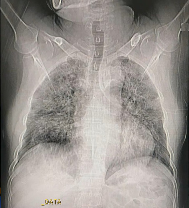 Hình ảnh phổi người mắc COVID-19 ở Việt Nam - Ảnh 2.