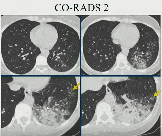 Hình ảnh phổi người mắc COVID-19 ở Việt Nam - Ảnh 3.