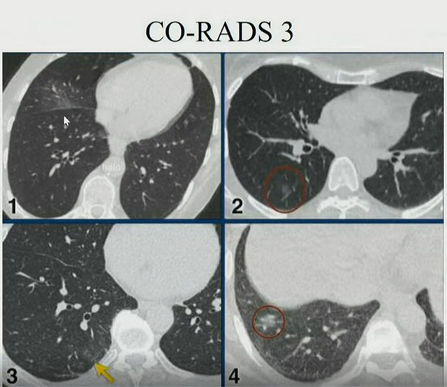 Hình ảnh phổi người mắc COVID-19 ở Việt Nam - Ảnh 4.