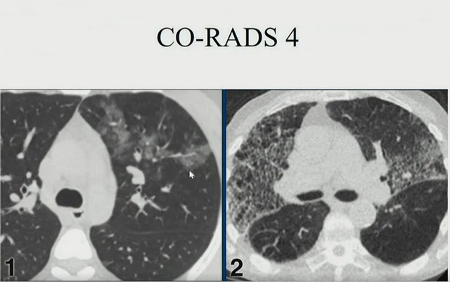 Hình ảnh phổi người mắc COVID-19 ở Việt Nam - Ảnh 5.