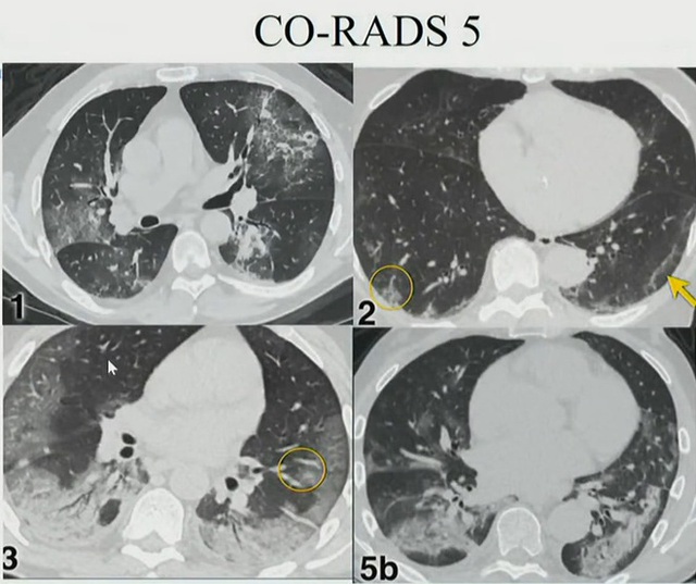Hình ảnh phổi người mắc COVID-19 ở Việt Nam - Ảnh 6.