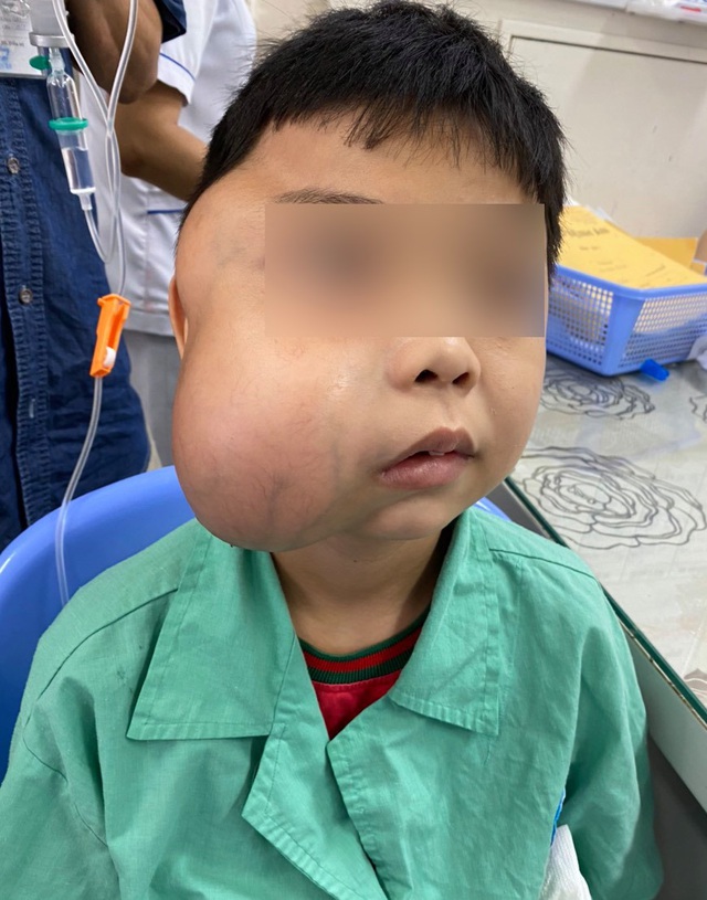 Phẫu thuật thành công bé trai bị u xơ vòm mũi họng khổng lồ - Ảnh 1.