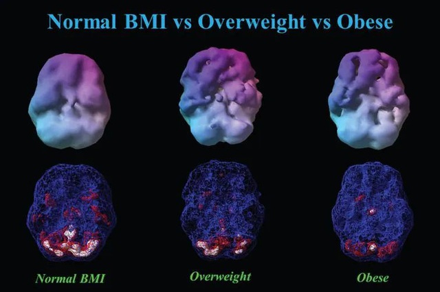 Cân nặng ảnh hưởng thế nào đến não? Kết quả đáng sợ khi quét não  - Ảnh 3.