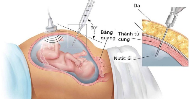 Sàng lọc trước sinh là gì và những điều mẹ bầu cần biết - Ảnh 1.