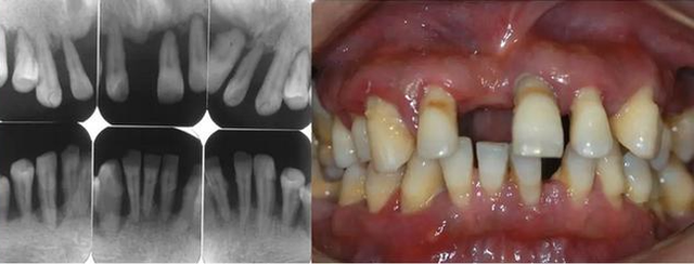 Người đàn ông 31 tuổi đi khám vì răng lung lay, bác sĩ quyết định nhổ tất cả răng vì sai lầm từ 2 năm trước của anh - Ảnh 3.