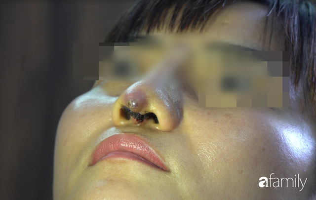 Người phụ nữ bị đứt lìa trụ mũi, chảy dịch và máu sau 12 ngày đi nâng mũi chui - Ảnh 1.