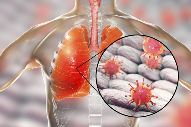 5 căn bệnh gây tử vong cao nhất và cách phòng chống - Ảnh 3. 5 căn bệnh gây tử vong cao nhất và cách phòng chống - Ảnh 3.