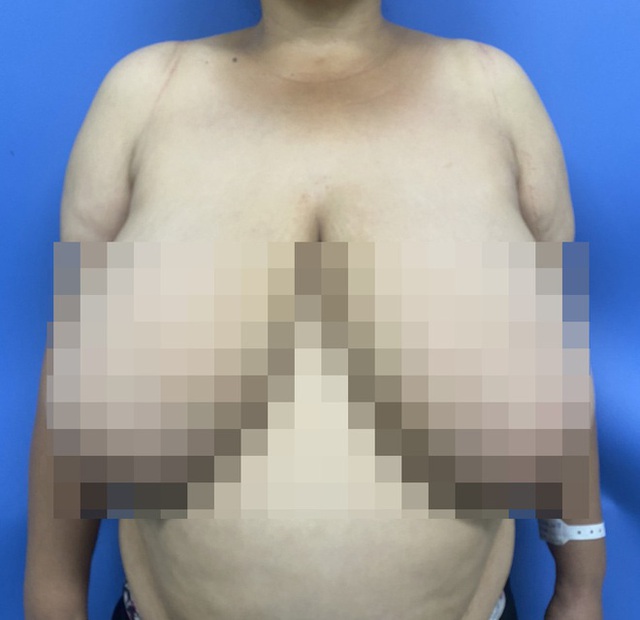 Người phụ nữ mang bộ ngực khổng lồ suốt 28 năm - Ảnh 1.