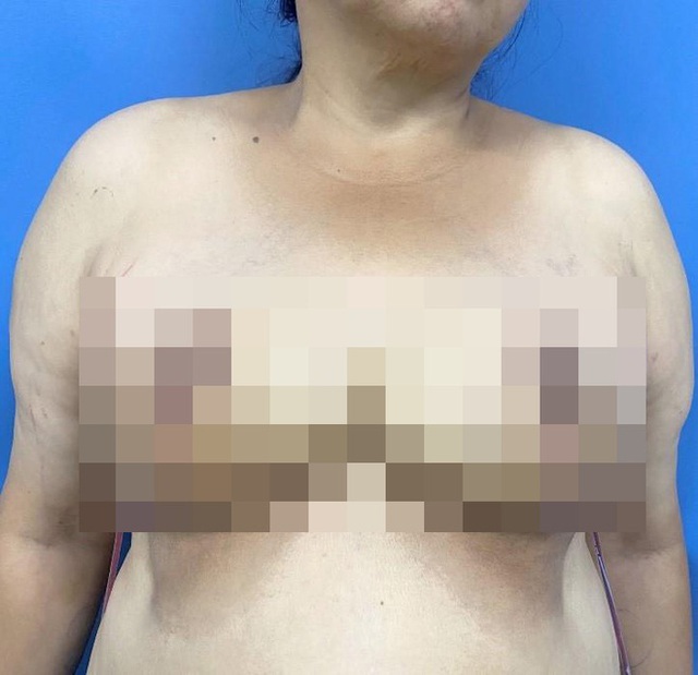 Người phụ nữ mang bộ ngực khổng lồ suốt 28 năm - Ảnh 2.