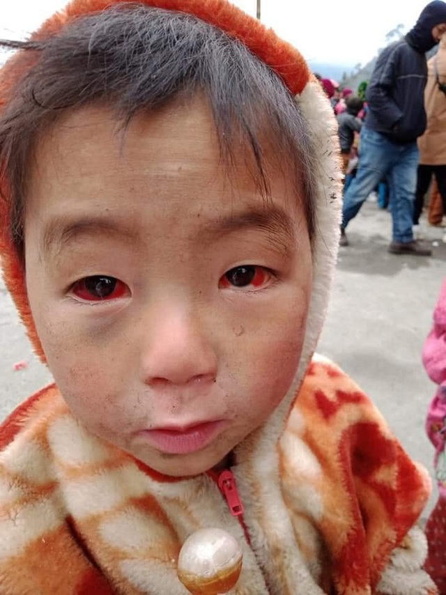 Tấm ảnh cháu bé miền núi phía Bắc bị xuất huyết dưới kết mạc do thời tiết rét lạnh đỏ ngầu cả 2 mắt: BS chuyên khoa Mắt nói sự thật về nguyên nhân - Ảnh 1.