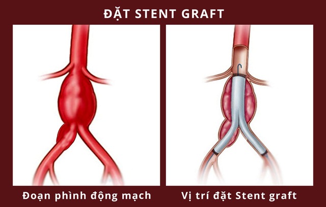  Người đàn ông mạch máu khổng lồ suýt vỡ được cứu như thế nào?  - Ảnh 1.