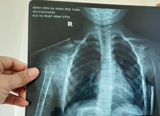 Sơn La: Bé trai 4 tuổi bị gãy xương đòn khi rời trường mầm non về nhà - Ảnh 2.