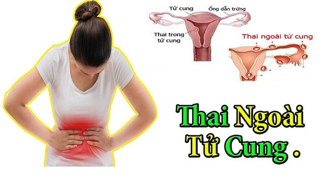 Cô gái 27 tuổi đột ngột lên cơn đau bụng lúc nửa đêm, bác sĩ chỉ định mổ cấp cứu thì thấy bụng bệnh nhân đầy máu - Ảnh 2.