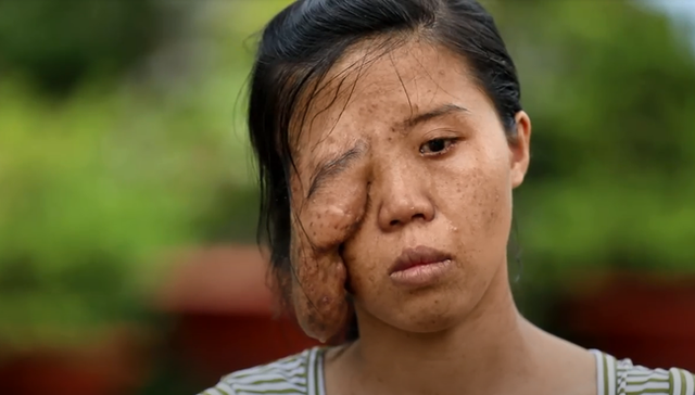 Mẹ đơn thân một mắt và 3 cuộc đại phẫu thay đổi cuộc đời, phản ứng khi con gái gặp lại mẹ tuy bẽ bàng nhưng ai cũng phải rớt nước mắt - Ảnh 5.