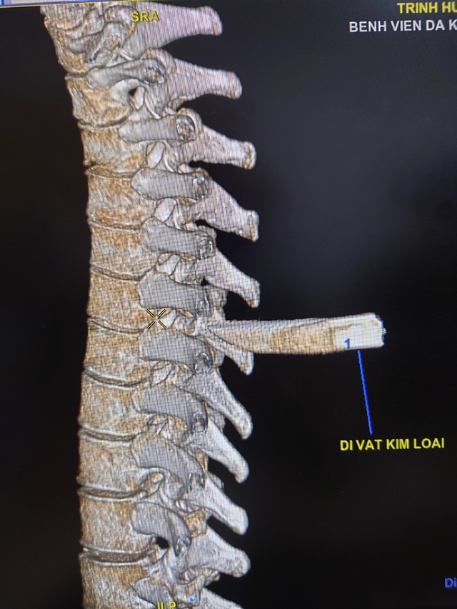  Nam thanh niên nhập viện với mũi dao đâm thẳng vào cột sống  - Ảnh 1.