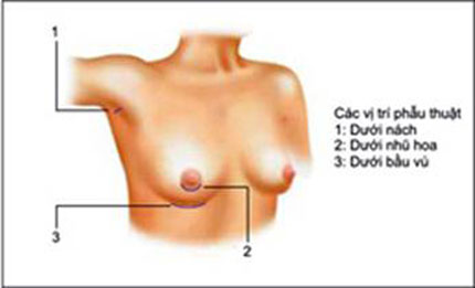 Chuyên gia nói về nâng ngực an toàn  1