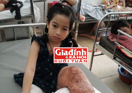 Nghiệt ngã cuộc đời bé gái trong 10 năm trải qua 11 ca phẫu thuật vì căn bệnh khiến chân “tự lớn lên” 2