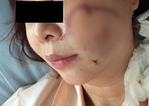 Bị kẻ t&aacute;n tỉnh rạch mặt c&ocirc; g&aacute;i xinh đẹp phải giải phẫu thẩm mỹ 2