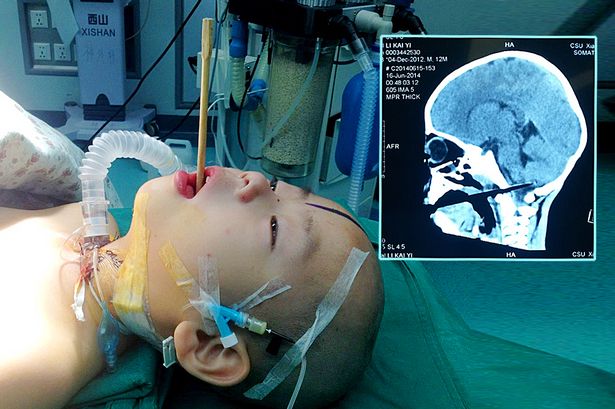 Cậu b&eacute; bị đũa đ&acirc;m xuy&ecirc;n n&atilde;o vẫn may mắn tho&aacute;t chết 1