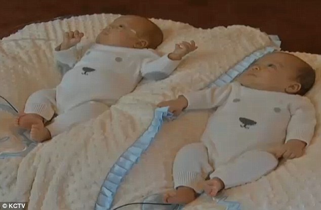 Hai bé trai song sinh chào đời cách nhau hơn 1 tháng 2