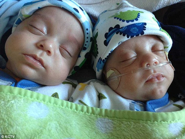 Hai bé trai song sinh chào đời cách nhau hơn 1 tháng 1