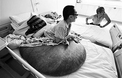 Liệt giường vì khối u khổng lồ, nặng 100kg trên người 1