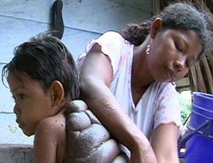 Cậu b&eacute; c&oacute; vết bớt "khủng" như mai r&ugrave;a 2
