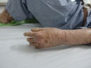 Cô gái 29 năm chiến đấu với căn bệnh lột da như rắn - GDN