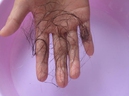 Những dấu hiệu lạ trên cơ thể giúp bạn phát hiện bệnh ung thư trước vài năm Những dấu hiệu lạ trên cơ thể giúp bạn phát hiện bệnh ung thư trước vài năm