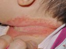 Sai lầm khi chữa rôm sẩy cho trẻ nhiều phụ huynh hay mắc phải