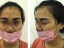 Chị em gặp họa vì muốn làm đẹp tức thì, chuyên gia cảnh báo tuyệt đối không tiêm filler nâng mũi ở những cơ sở spa