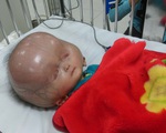 Thông tin mới nhất về bé trai 13 tháng tuổi mắc bệnh có đầu to bất thường