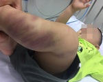 Công an Hà Nội khởi tố vụ bé trai 1 tuổi bị bạo hành đến co giật, hôn mê