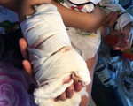 Bé trai bị thang cuốn ở sân bay Tân Sơn Nhất được mổ nối gân tay