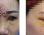 Cô gái trẻ mù mắt, mặt mũi biến dạng vì tiêm chất làm đầy mũi ở spa Đài Loan
