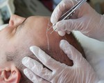 Chi gần 200 triệu đồng để cấy tóc chữa hói đầu, doanh nhân Ấn Độ chết thảm vì dị ứng